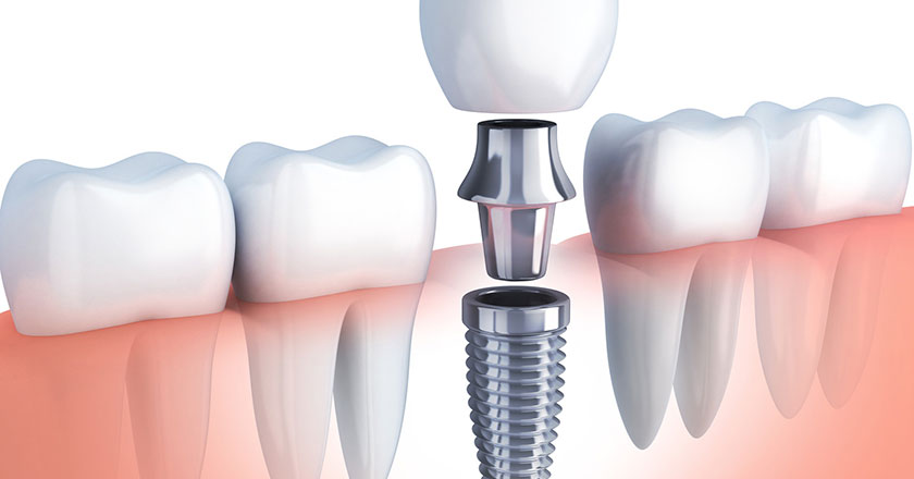 Impianti-Dentali-All-On-Six-Dentista