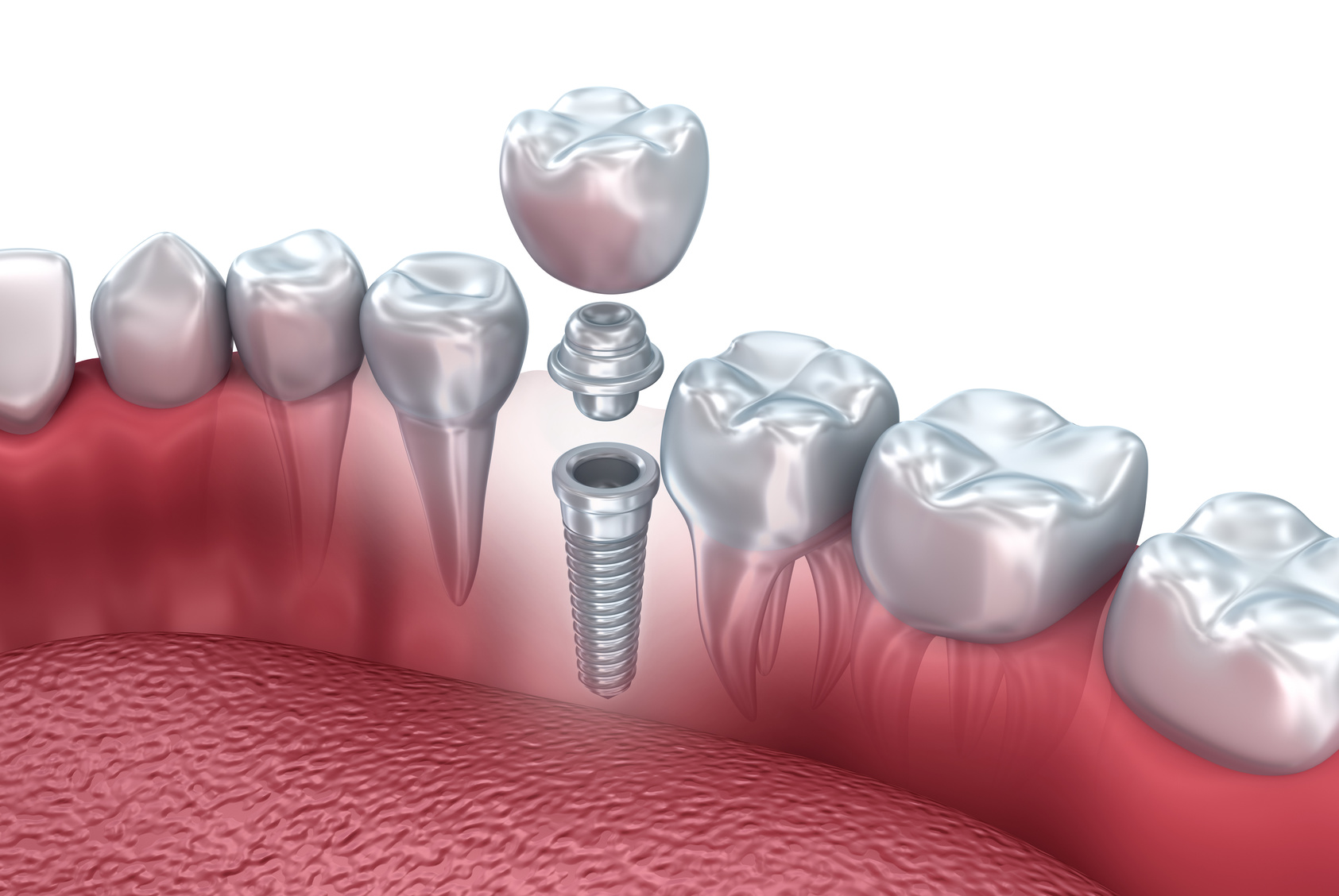 Kit Periotomi Dentali Beaden® Con Punte Micro Seghettate Blu - 2 Pezzi Per Chirurgia Implantare