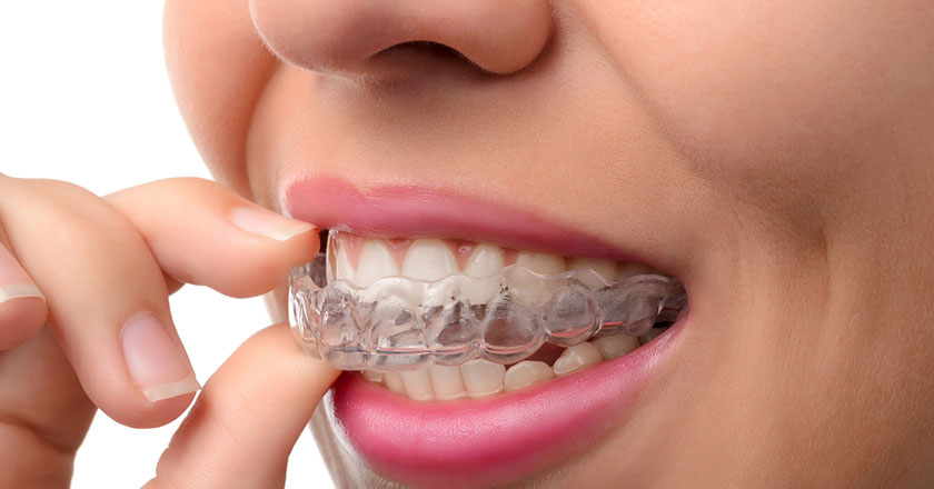 Apparecchio-Ortodontico-Trasparente-Dentista.Tv