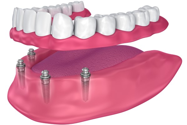 Riabilitazione implantoprotesica removibile