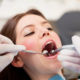 Carie dentali otturazione